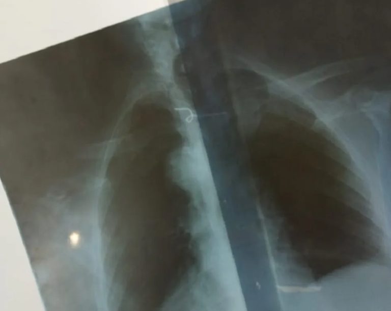 Idosa engole arame enquanto comia farinha e objeto fica preso no esôfago no RN