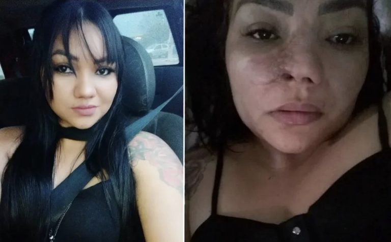 Mulher que perdeu parte do nariz após cirurgia estética: “Enganada”