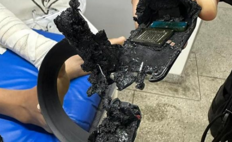 Tornozeleira eletrônica explode e causa ferimento de 3° grau em mulher