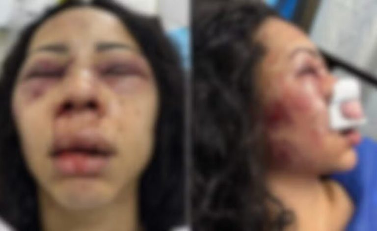 Turista brasileira é internada em estado grave após ser espancada durante assalto no Chile