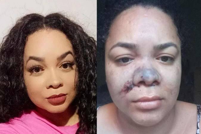 O perigo escondido no PMMA: denúncias crescem após caso fatal de influencer