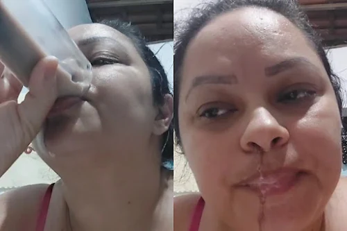 Mulher tem “céu da boca” perfurado ao realizar procedimento odontológico no interior do RN