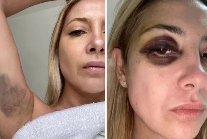 Acusado de agressão, Alberto Fernández diz que olho roxo em ex-primeira-dama foi causado por ‘tratamento contra rugas’