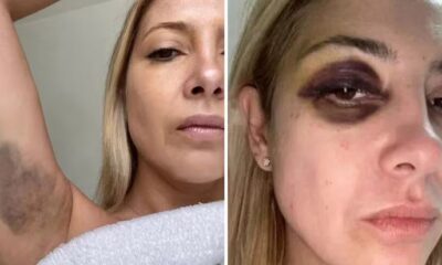 Acusado de agressão, Alberto Fernández diz que olho roxo em ex-primeira-dama foi causado por ‘tratamento contra rugas’