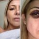 Acusado de agressão, Alberto Fernández diz que olho roxo em ex-primeira-dama foi causado por ‘tratamento contra rugas’