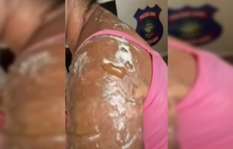 Cliente é queimada com manteiga quente durante discussão em lanchonete